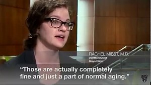 Psoriasis can affect fingernails and toenails, causing pitting, abnormal growth and discoloration. August is Psoriasis Awareness Month. And experts at Mayo Clinic say it's important to keep an eye on your nails, as they can provide clues to your overall health. https://mayocl.in/3Q20KTe | Mayo Clinic