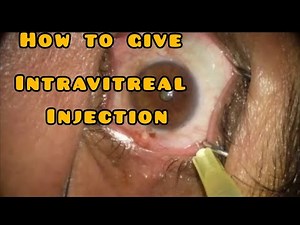 How to giveintravitreal injection