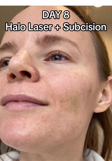 Day 8 After Halo Laser and Subcision for Acne Scars