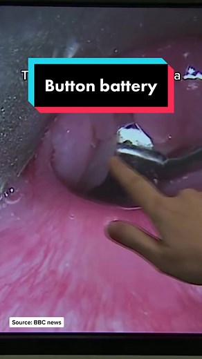 Button Battery Ingestions: Honey as First Aid Treatment