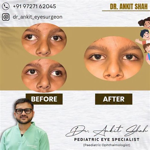 Dr.Ankit Shah | Squint Surgeon on Instagram: "Alternate exotropia in the pediatric age group is a common form of strabismus (eye misalignment) where one eye deviates outwards while the other maintains fixation, with the deviation alternating between the eyes. This means sometimes the right eye turns out, and sometimes the left eye turns out, while the other eye is looking straight.the definitive treatment for persistent or frequent exotropia, especially if non-surgical methods are unsuccessful. 