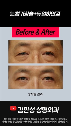 [중년 눈성형] 중년 남자 상안검/하안검/눈썹거상술 전후사진 #shots