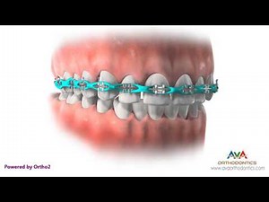 Space Closure by Power Chain - Orthodontic Treatment