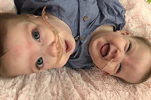 Mom recalls her conjoined twins’ risky separation surgery