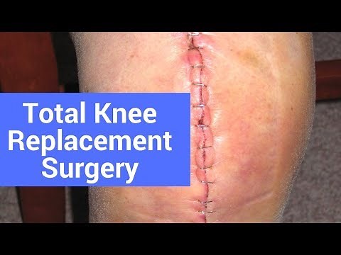 What Happens After Total Knee Replacement Surgery