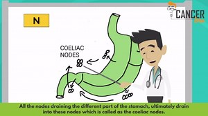 Stomach cancer staging