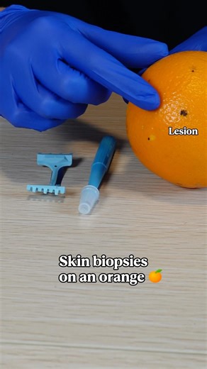 Quick skin biopsy demo on an orange 🍊 #dermatology #biopsy #skin #medical