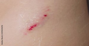 Womans hand sprays an antiseptic agent on the wound. Treatment the wound. First Aid