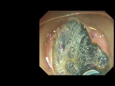 “7 cm Colon LST ESD – Perforation Happened… Here’s How We Managed It”
