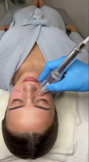 Blackhead Popping Techniques 2025 – Best Methods ✨