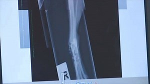 It’s a worrying time for Chris and Becky as they see the extent of 4-year-old Barney’s devastating injuries to his back leg on x-ray for the first time after he was hit by a bus. Head over to Channel 4 ready for The Supervet at 8pm to follow his journey. #Supervet | The Supervet