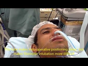 awake nasal fiberoptic intubation