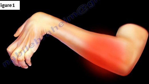 Volkmann’s Ischemic Contracture