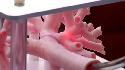 North Memorial Health Hospital uses new technology to detect lung cancer cases