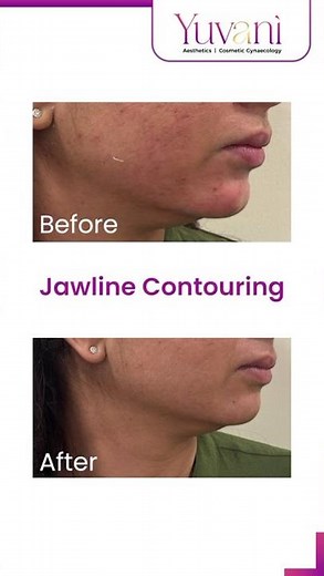 How Chin & Jawline Contouring Enhances Facial Symmetry