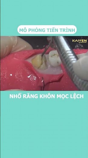 Mô phỏng quy trình nhổ răng khôn mọc lệch