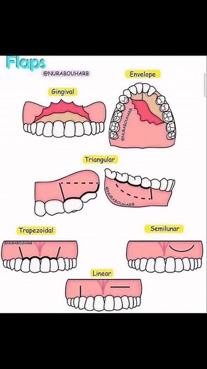 Dentalschool🥇 on Instagram: "Types of flaps in oral surgery. A flap is a section of soft tissue outlined by a surgical incision. It carries its own blood supply, permits surgical access, and when replaced and sutured is expected to heal by primary intention. A full-thickness mucoperiosteal flap includes the surface mucosa, submucosa and the periosteum. Flap design in dentoalveolar procedures varies depending on the procedure, access, aesthetics and, operator preference. Despite the variation, c