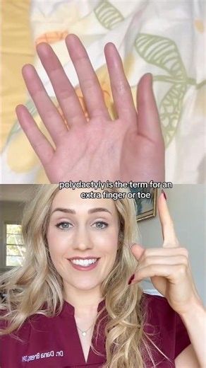 Doctor reacts: born with 6 fingers?!