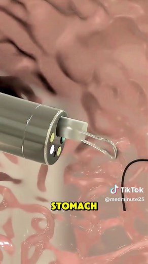 Understanding the PEG Procedure: A 3D Animation Guide
