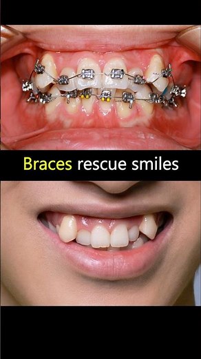 Braces fix crooked teeth. Rescue his smile ##braces #orthodontist #smile #teeth #dentist