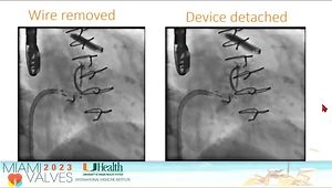 Management of Mitral Paravalvular Leak