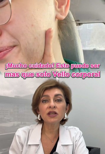 Hirsutismo: Causas y Tratamientos Efectivos
