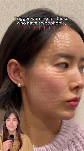 Support skin with lifting PDO threads – without surgery or scars! Instantly lift & tighten skin while boosting collagen for long-lasting firmness. ▫️ Non-surgical, minimally invasive skin tightening ▫️ Thin, dissolvable threads stimulate collagen & improve skin elasticity ▫️ Results keep improving over the long term as collagen rebuilds ▫️ Long lasting ~12 months depending on personal factors ▫️ Targets jawline, cheeks & neck for a lifted, supported appearance ▫️ Completed in 1 hour, usually bac