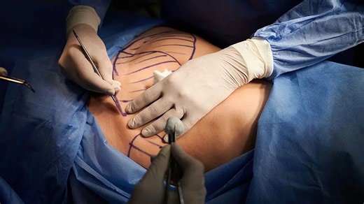 Benefits and side effects of liposuction