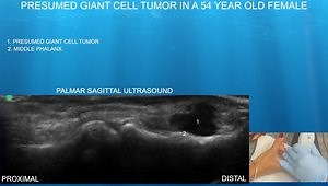Presumed Giant Cell Tumor in a 54 Year Old Female