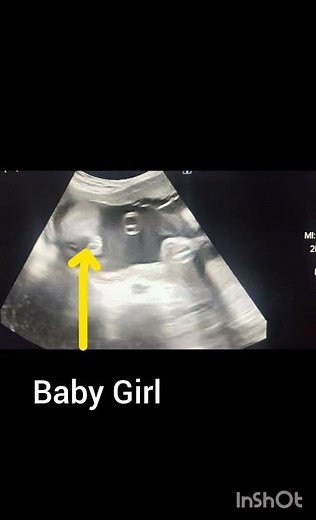 Obstetric Ultrasound showing Baby Girl! Gender reveal ultrasound!#ultrasoundmadeeasy86#radiology