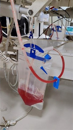 Intercostal Drain (ICD)