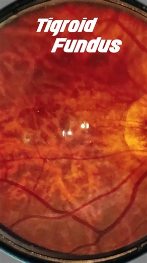 Tigroid Fundus | Smartphone Fundus Videography | Fundus Photography | Short Video 511