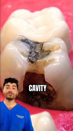Dentist Explains: How To Fix A Cavity !?