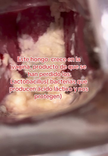 Cándida: Soluciones Integrales para la Salud Vaginal