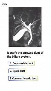 🔍 Anatomy Quiz: Can You Identify This Structure? 🔎 This MRCP image highlights a small yet essential duct that connects the gallbladder to the common bile duct, playing a crucial role in bile transport. Can you name this anatomical structure? Drop your answer in the comments! Challenge your hepatobiliary anatomy knowledge and stay tuned for the correct answer and more fascinating imaging insights! --- #RadiologyBuzz #MRCP #HepatobiliaryImaging #RadiologyQuiz #DiagnosticImaging #RadiologyLife #M