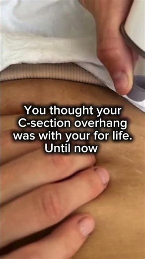 How to Improve Your C-Section Scar and Overhang