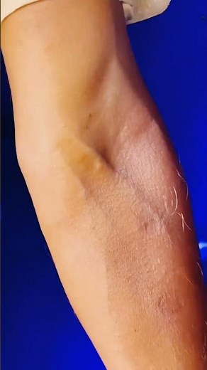 blood collection procedure #bloodcollection