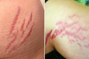 ‘Cat scratch fever’ can trigger mental health symptoms in humans, experts warn