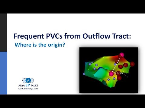 Frequent PVCs from Outflow Tract: Where is the Origin?