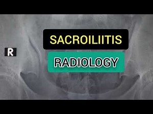 Sacroiliitis # X-Ray Pelvis # Radiology