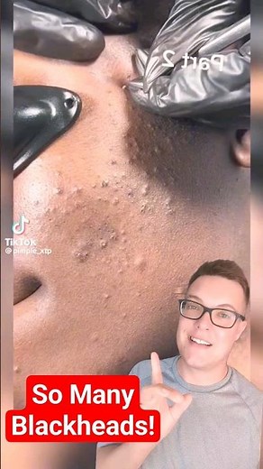 SUPER SATISFYING BLACKHEAD REMOVAL #shorts