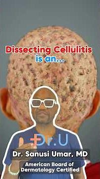 WHAT IS DISSECTING CELLULITIS?