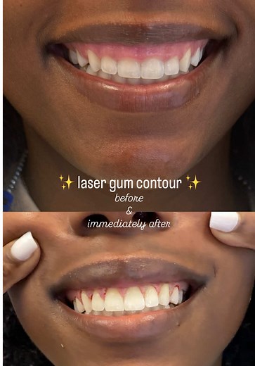 Transforming Gummy Smiles with Natural Laser Contouring