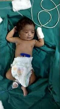 Neonatal seizures (Convulsions)