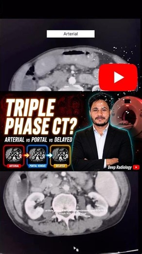 CT Triple Phase Explained | HCC Diagnosis Made Easy #shorts
