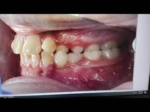 Orthodontic Crossbite Correction via an Expander