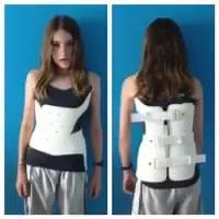 Scoliosis brace treatment (Generally recommended for curvatures 25 degrees and larger) If there ever was a time when a patient could benefit most greatly from chiropractic, therapeutic exercise, or non-surgical intervention, it would undoubtedly be during the mild stages of the disease - before the muscles & tissues of the body have been deformed by months or even years of compensating for the abnormal twisting & bending of the spine. Bracing dates back to approximately 650 AD, when Paul of Aegi