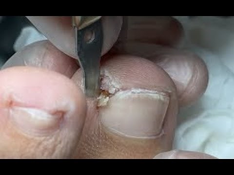 Pedicure tutorial: Big nail under toe corner, feel so much relief