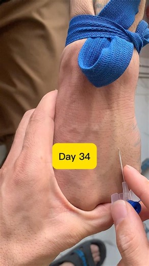 Advanced Blue IV Cannulation Trick! 💉 Day 34 #shorts #ivcannulation #nursingskills #safai#safi