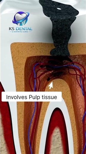 How a small cavity becomes a painful abscess 🦷